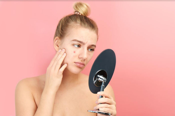 5 Ways to Treat & Prevent Hormonal Acne